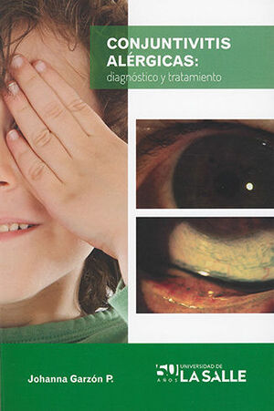 CONJUNTIVITIS ALERGICAS: DIAGNOSTICO Y TRATAMIENTO